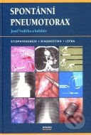 Spontánní pneumotorax - cena, srovnání