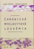 Chronická myelocytová leukémia - cena, srovnání